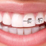 orthodontics - braces