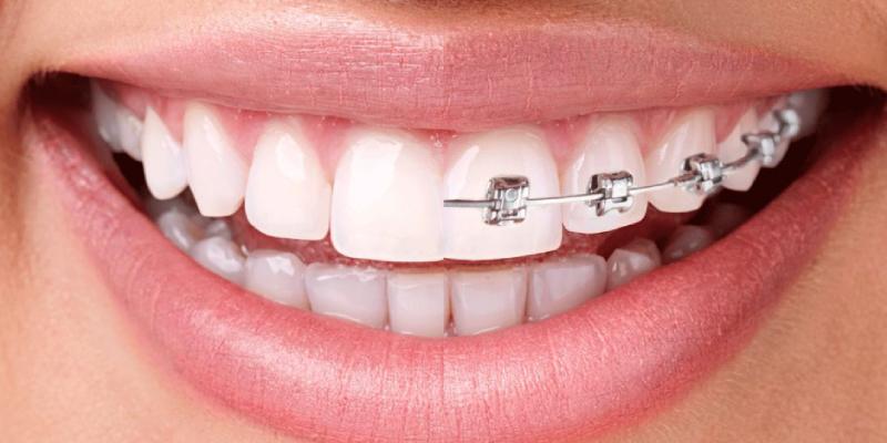 orthodontics - braces